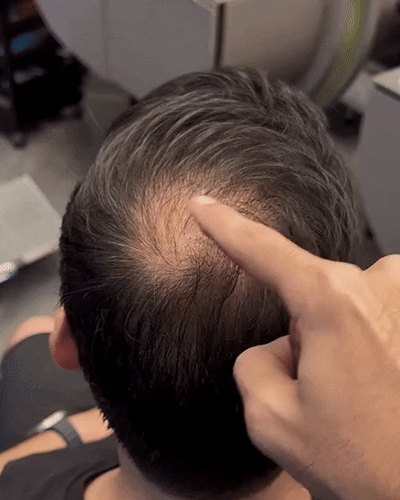 Applying Rooty 2.0 for a fuller-looking crown