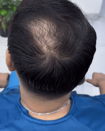 Rooty 2.0 filling in a thinning hairline